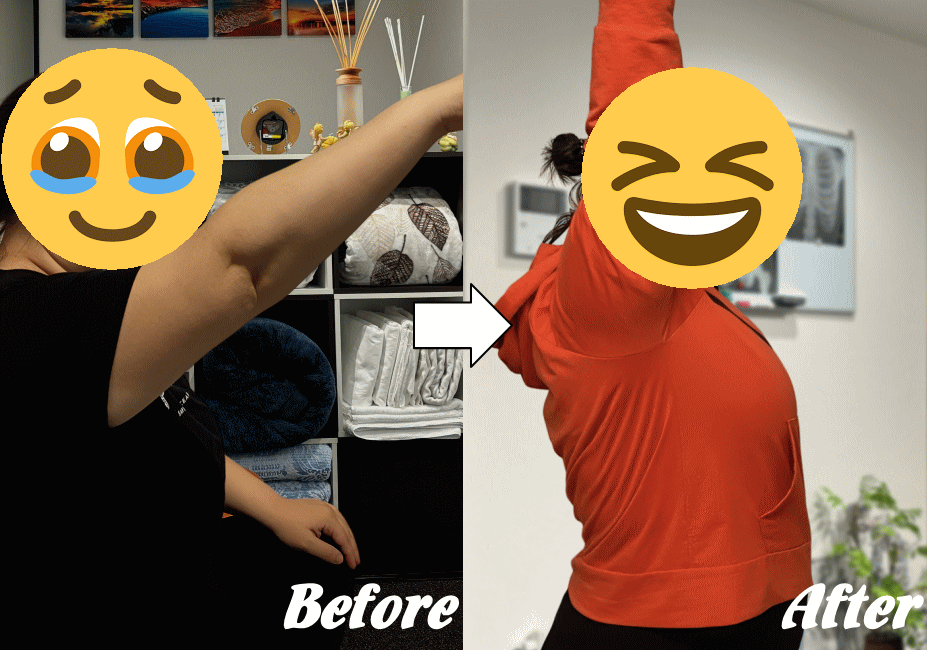 五十肩の施術の変化5