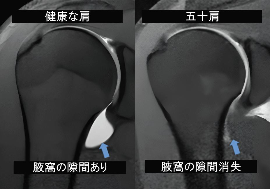 超音波検査でみた五十肩の状態
