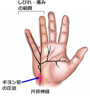 ギヨン管症候群による手の痛みや痺れ