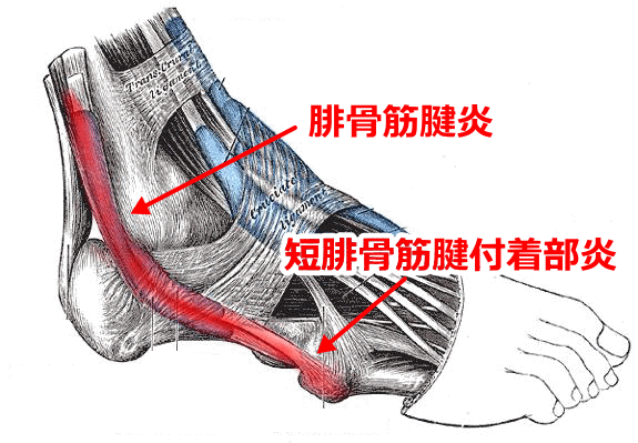 腓骨筋腱炎の箇所