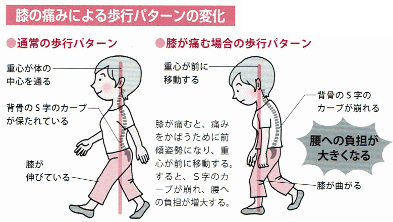 膝の痛みによる歩行パターンの変化