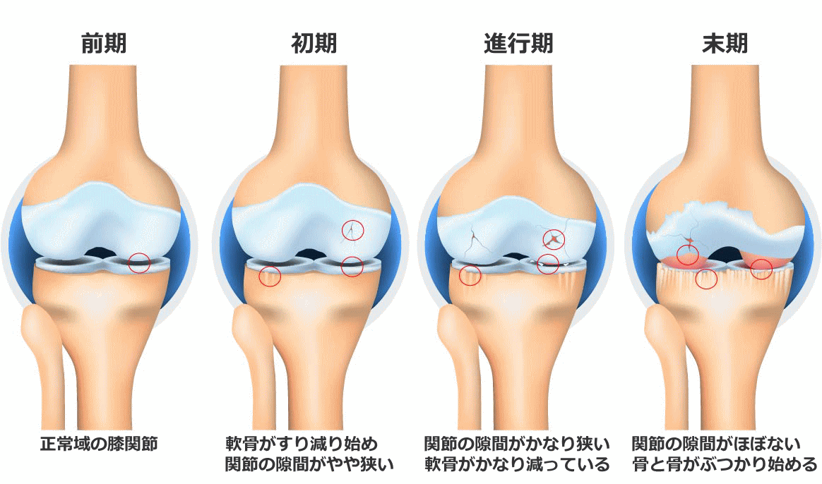 変形性膝関節症の進行度