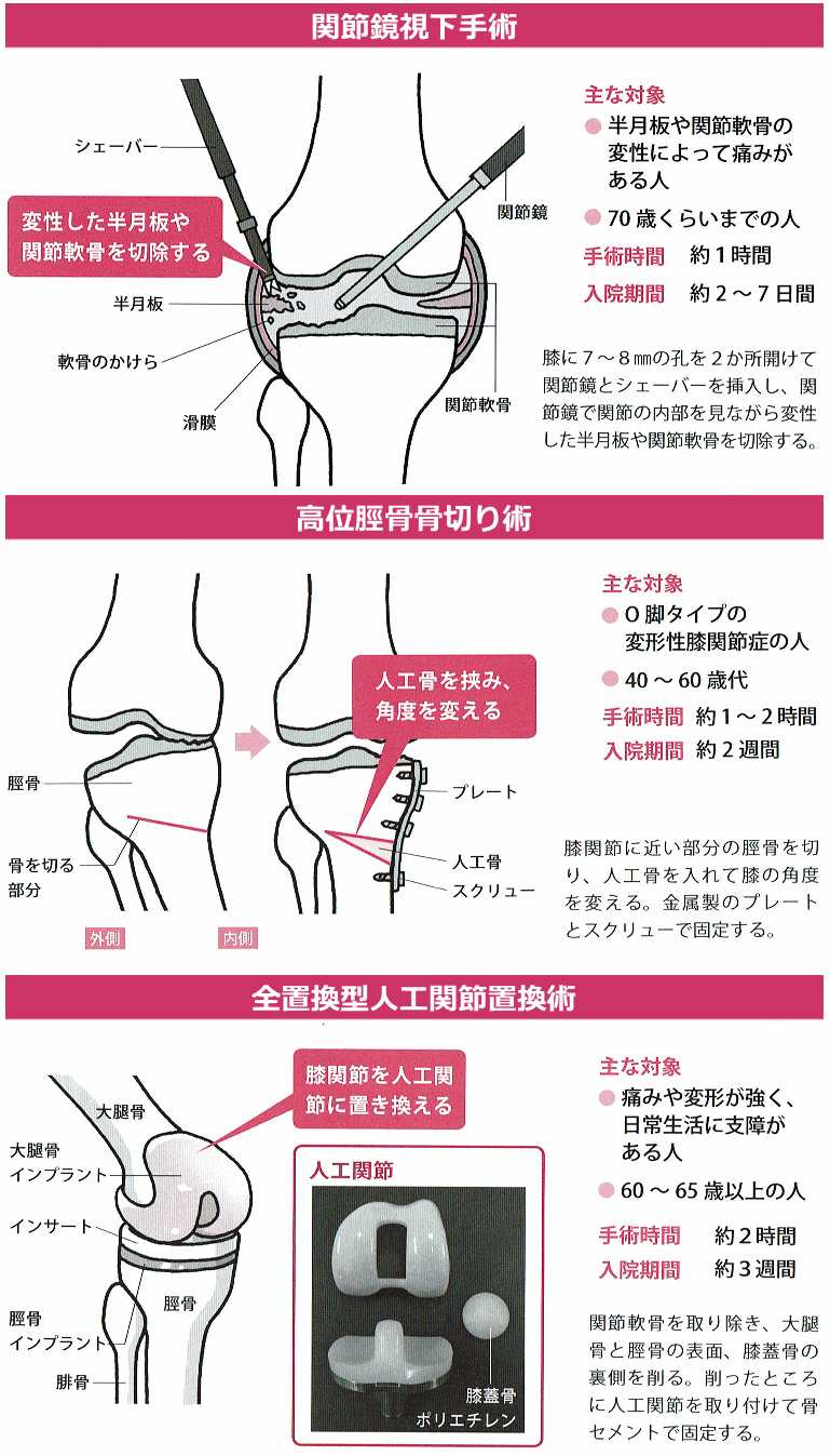 変形性膝関節症の病院治療