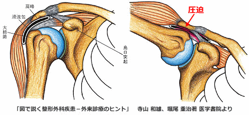 インピンジメント症候群の構造