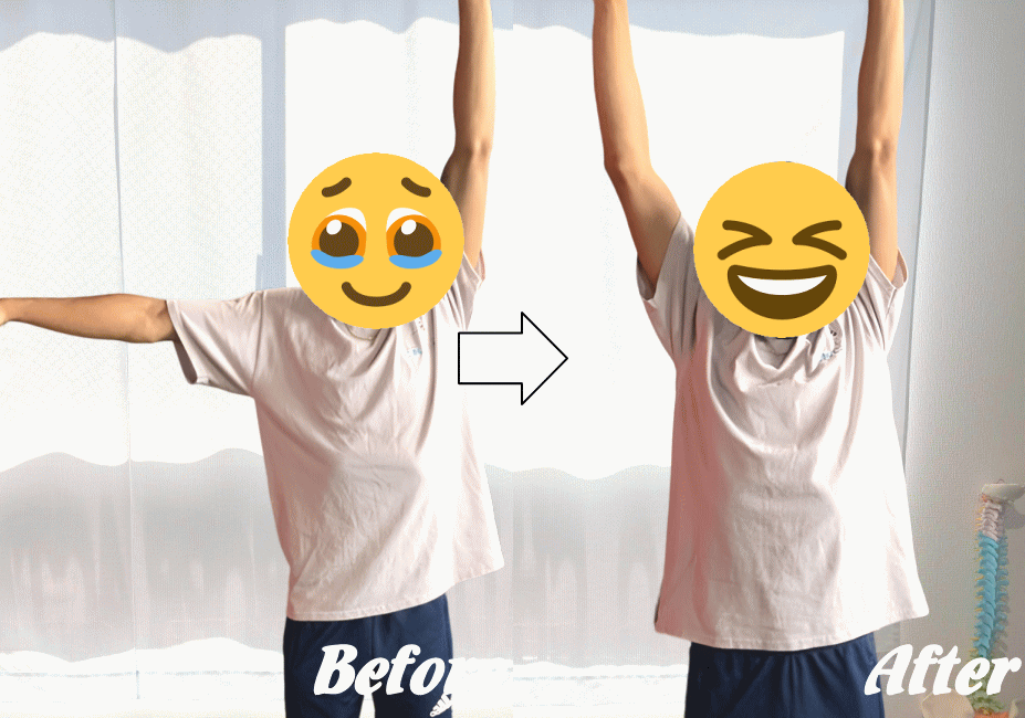 インピンジメント症候群の改善例1