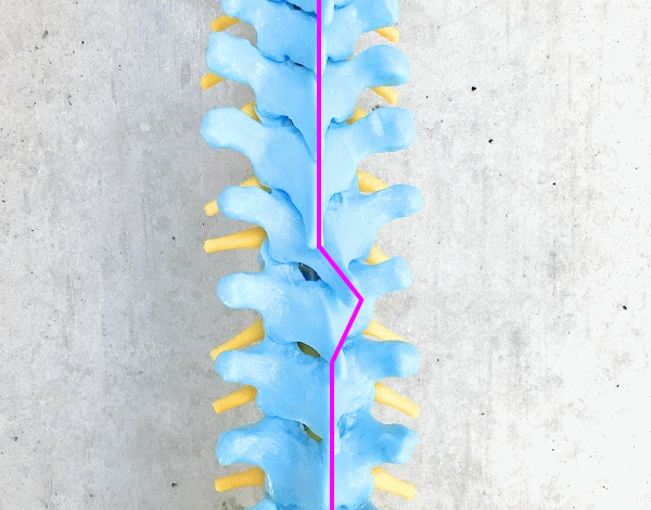 歪みのある脊柱