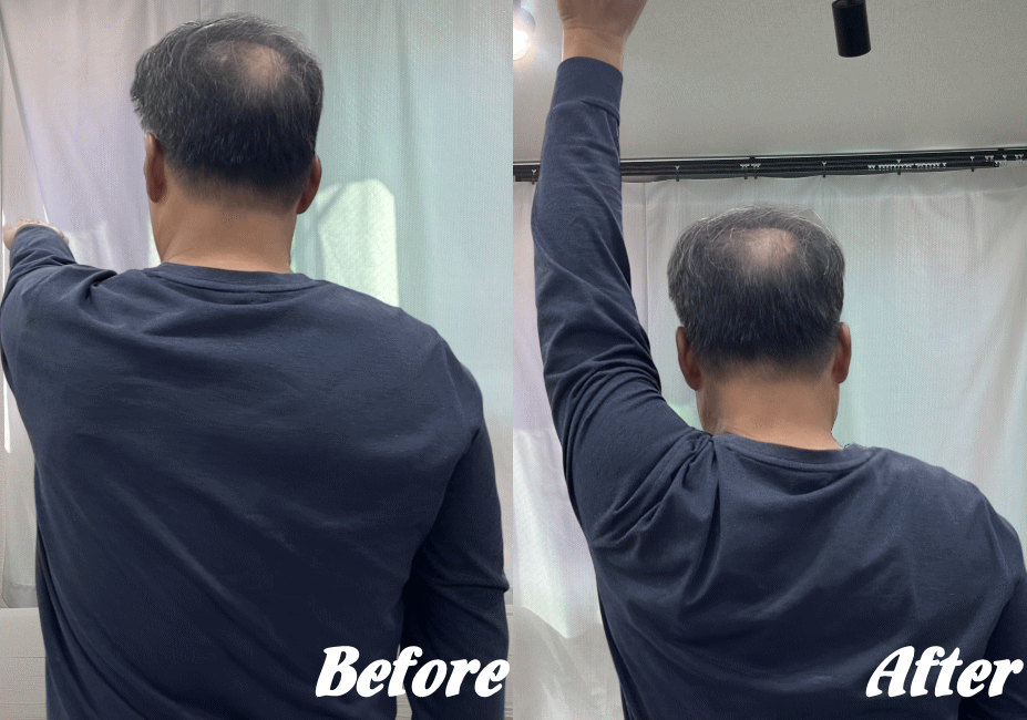 施術前と施術後32