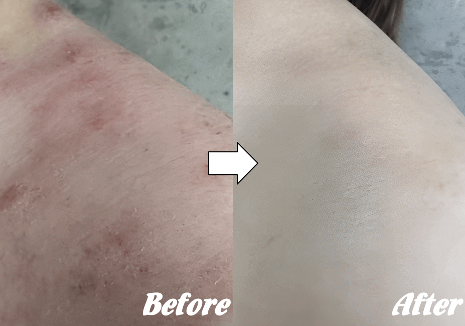 施術前と施術後F