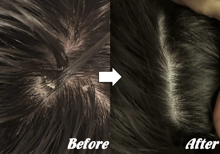 施術前と施術後H