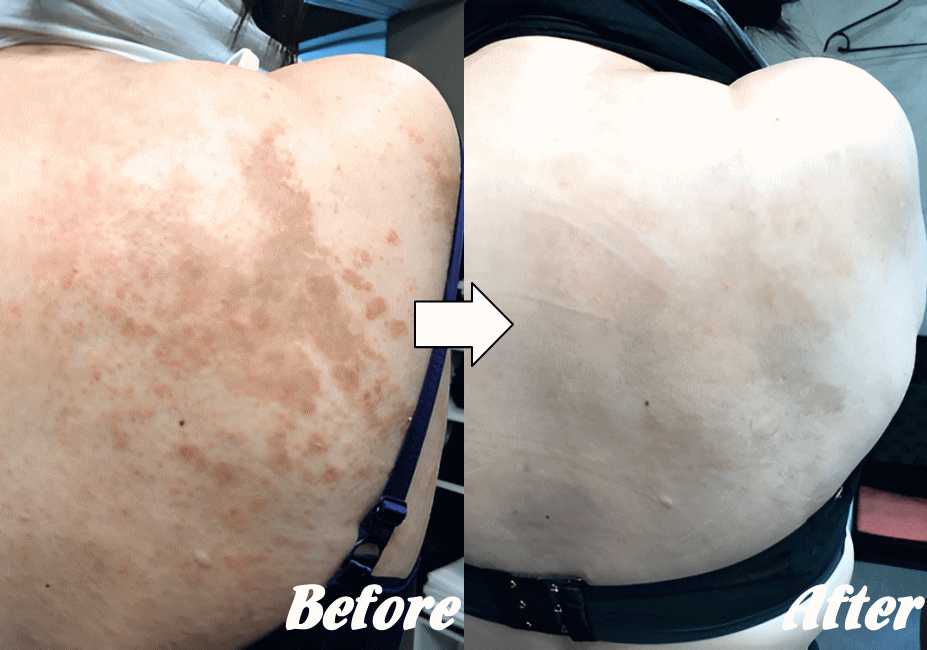 施術前と施術後K