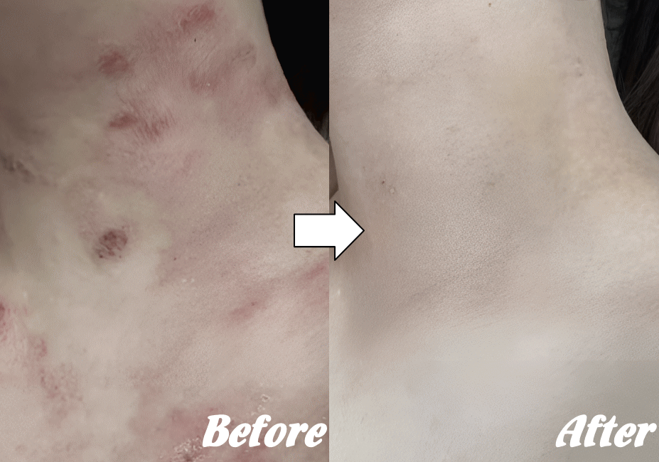 施術前と施術後L