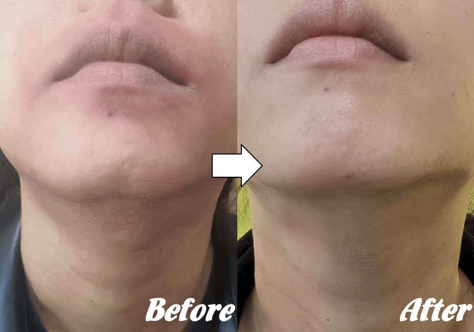 施術前と施術後M