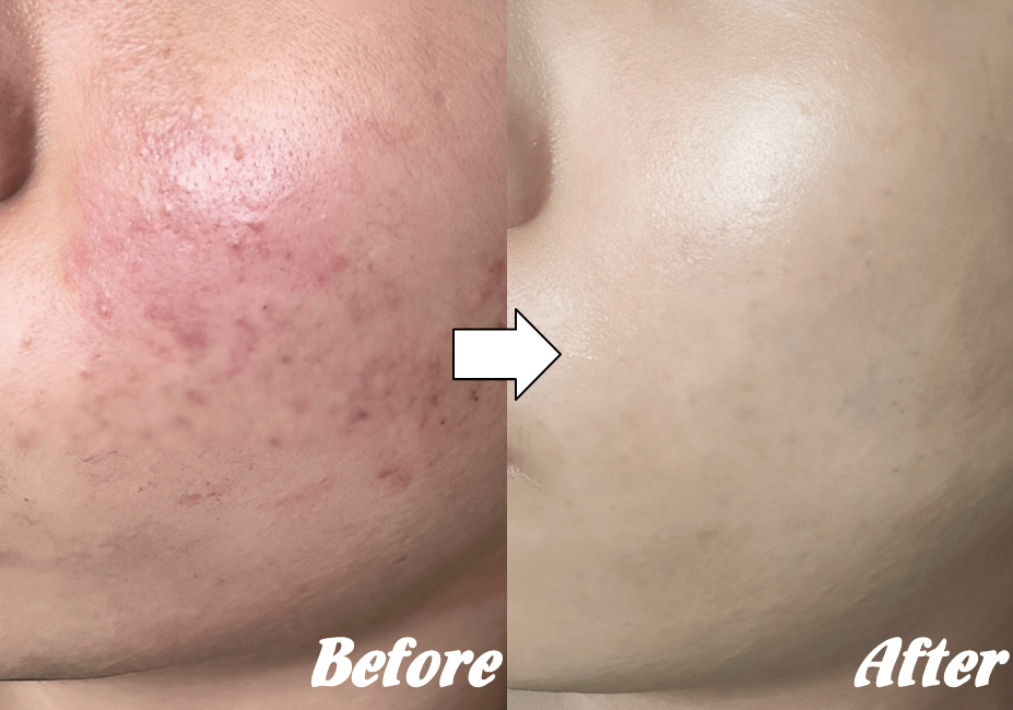 施術前と施術後P