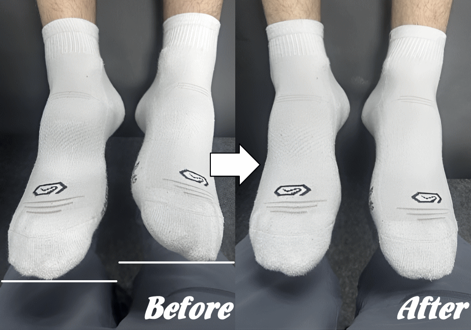 施術前と施術後10