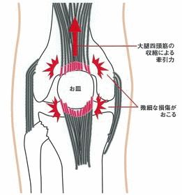 ジャンパー膝の痛みの箇所