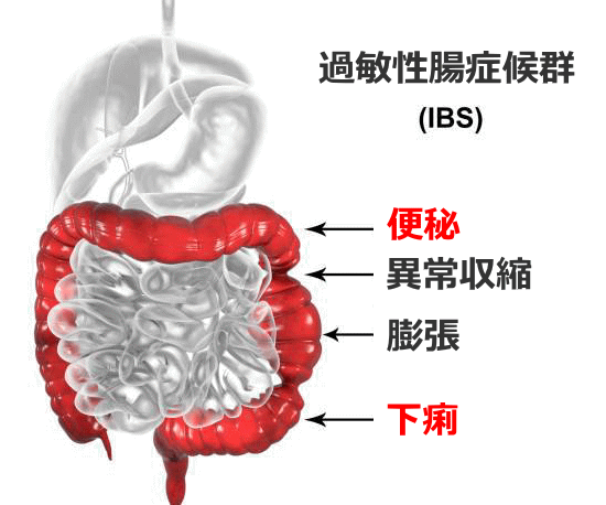 過敏性腸症候群