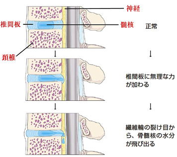 頚椎ヘルニアになる経緯