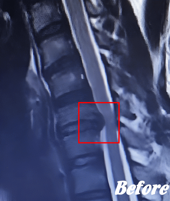 施術前の頚椎ヘルニア