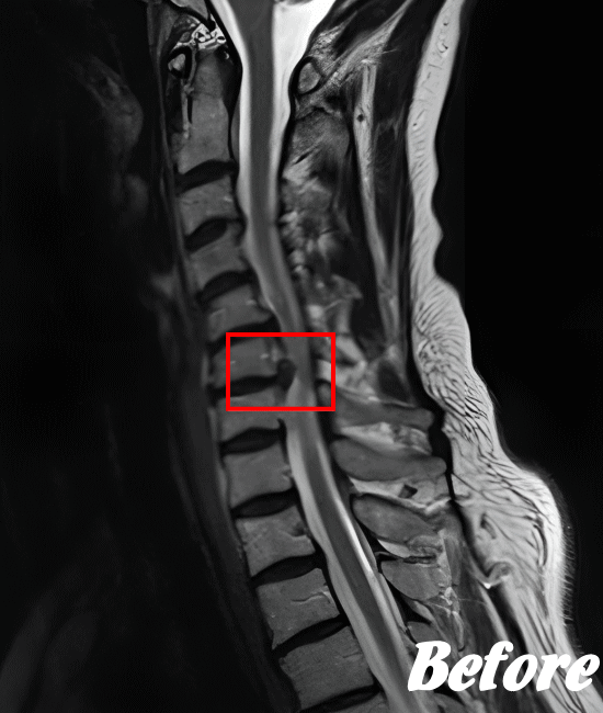 施術前の頚椎ヘルニア