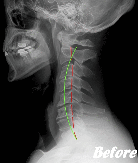 施術前の頚椎