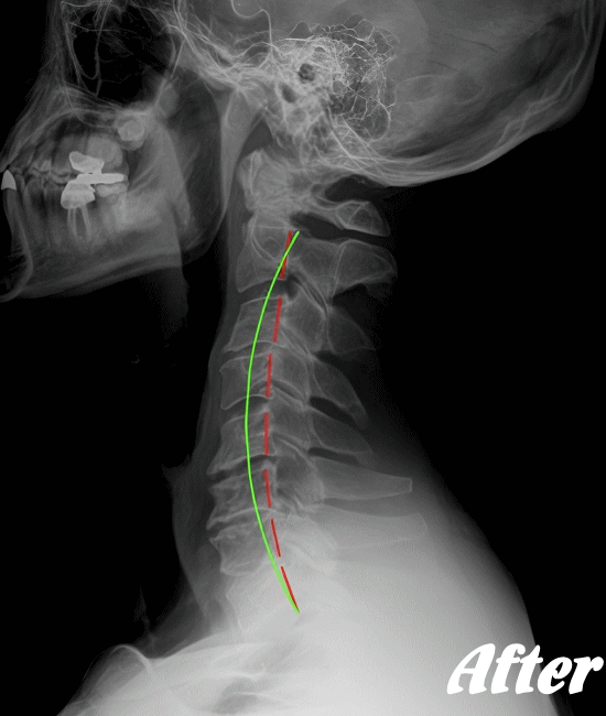 施術後の頸椎