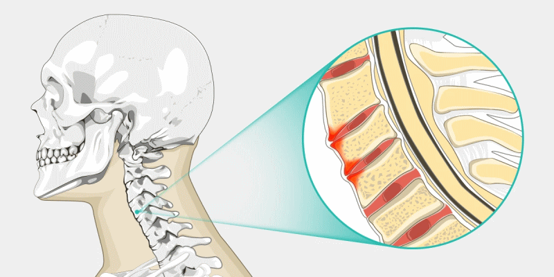 椎間板の変形による頚椎症