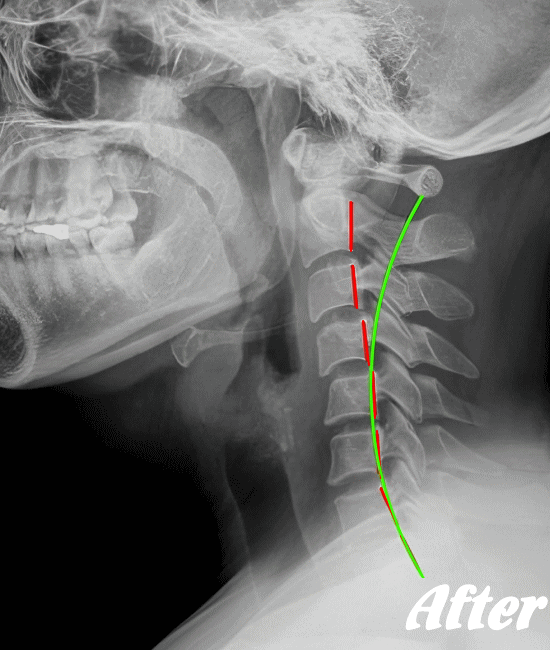 施術後の頸椎