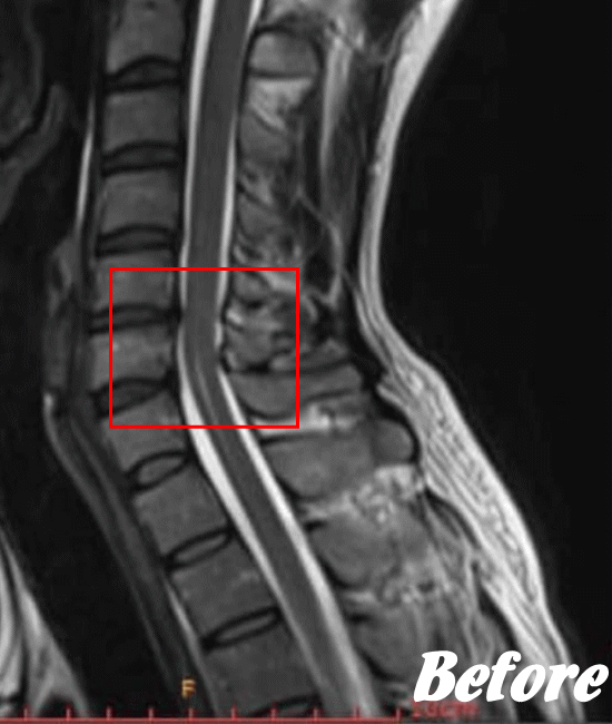 施術前の頚椎症