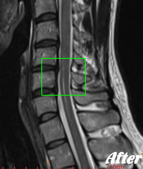 施術後の頸椎