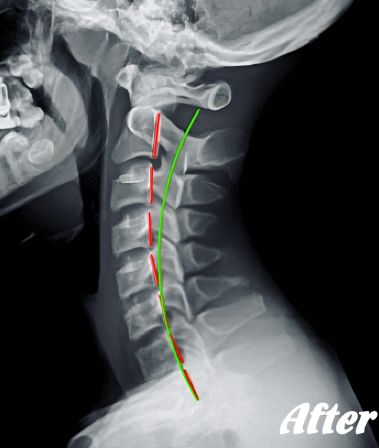 施術後の頸椎