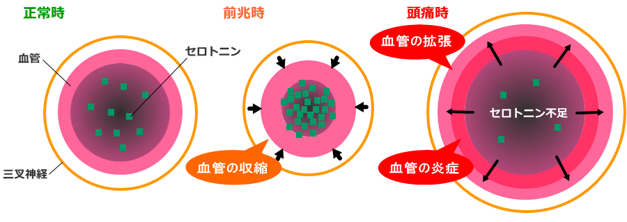 片頭痛時の血管と三叉神経とセロトニンの関係