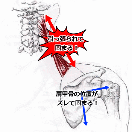 寝違えは肩甲骨の位置がズレて筋肉が伸ばされ固まった状態