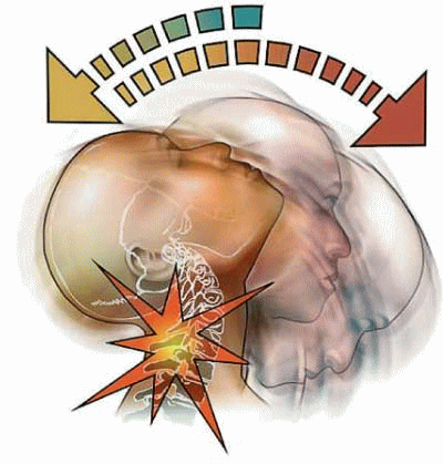 むち打ち症は首の稼働制限を超えてしまって起こる障害