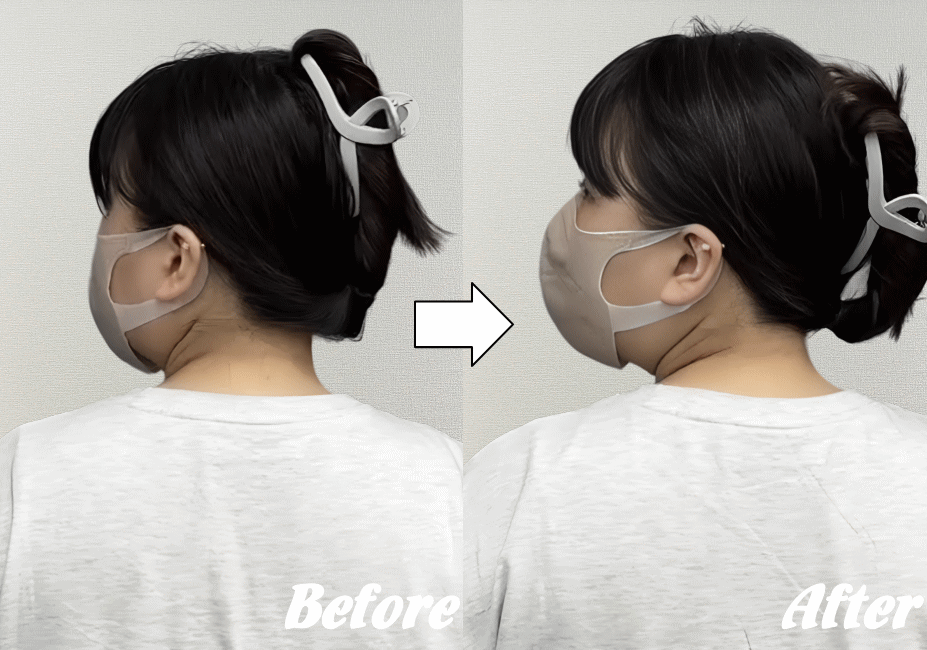 寝違えによる首痛