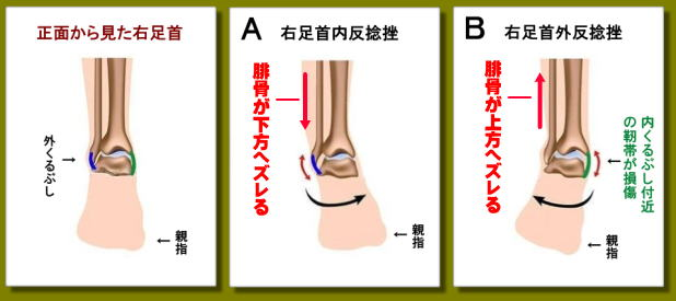 捻挫には内反捻挫と外反捻挫があります