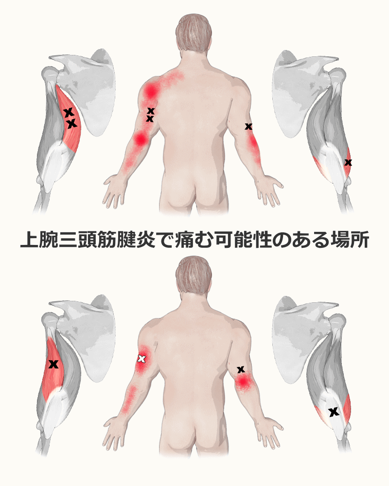 上腕二頭筋 つなぎ 肉離れ コレクション 軽度