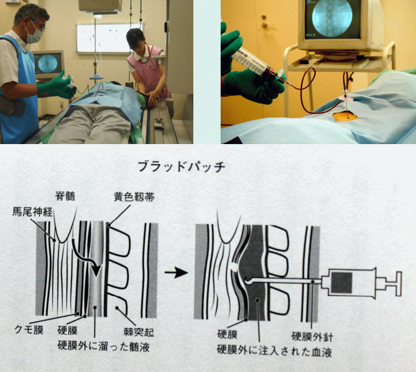 ブラッドパッチ術