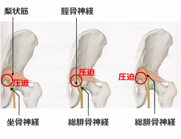 梨状筋症候群