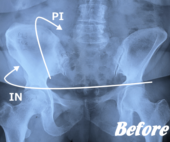 施術前の骨盤と腰椎