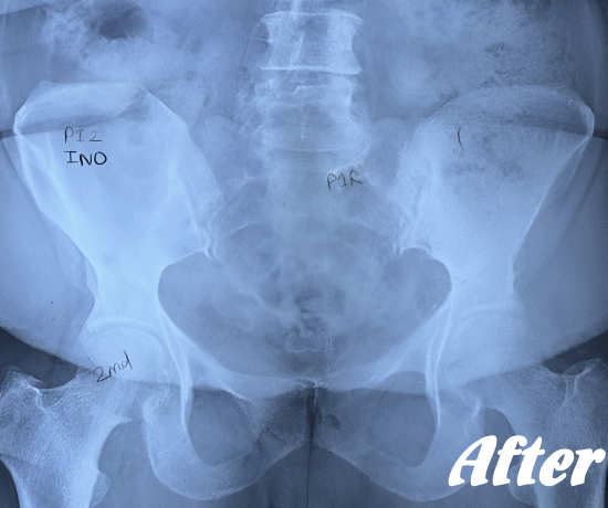 施術後の骨盤と腰椎