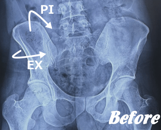 施術前の仙腸関節