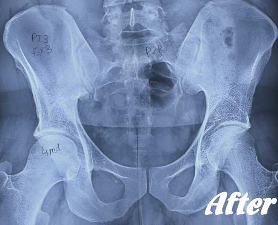 施術後の仙腸関節