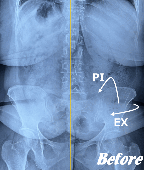 施術前の仙腸関節