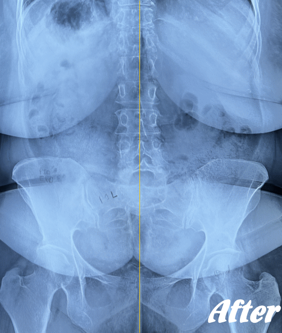 施術後の仙腸関節