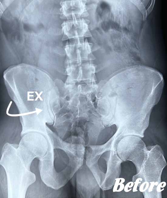 施術前の仙腸関節