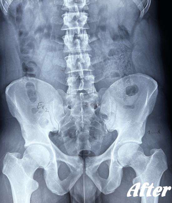 施術後の仙腸関節