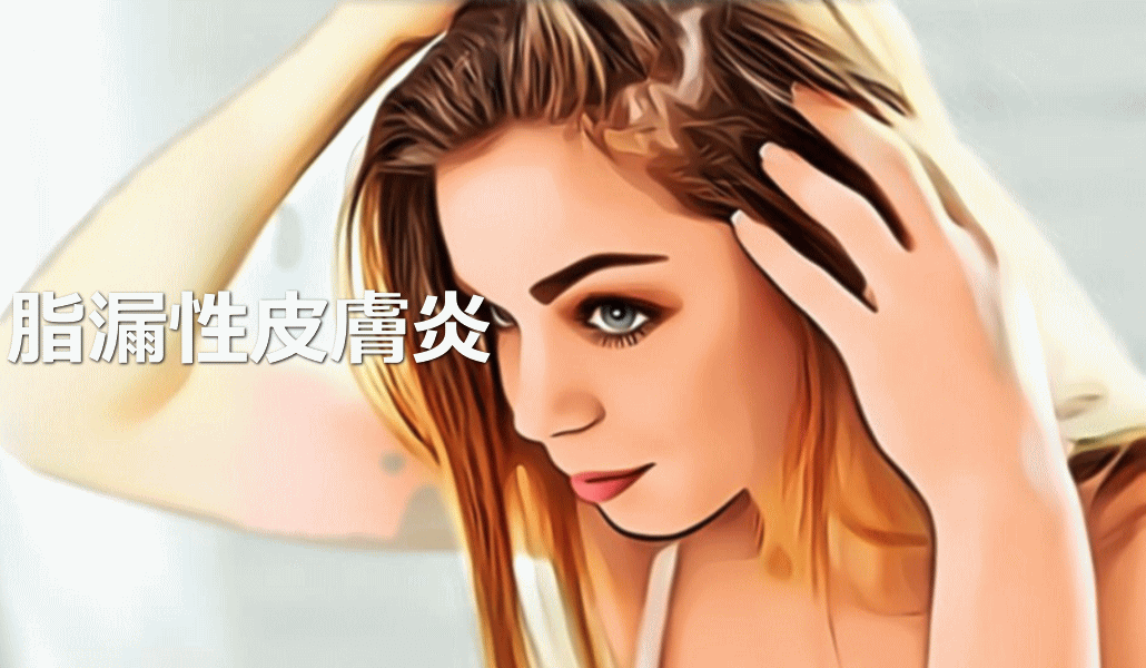 脂漏性皮膚炎