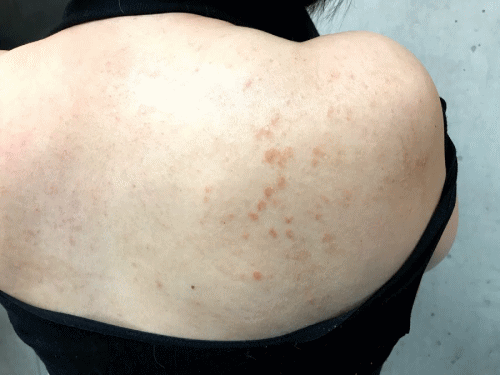 脂漏性皮膚炎に対する施術4月3日