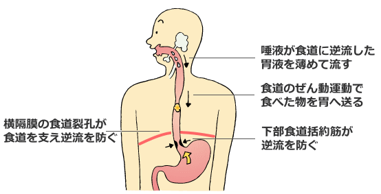 逆流性食道炎の構造