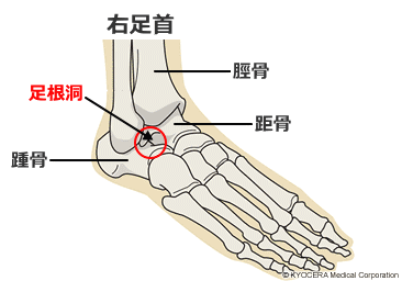足根洞症候群の箇所